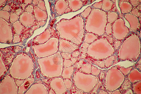 甲状腺胶体滤泡高清图片