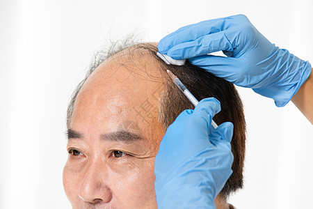 中年男性植发手术图片