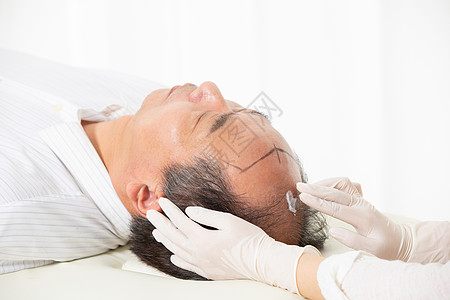 光头女中年男性植发手术背景