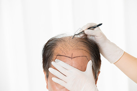 中年男性植发手术图片