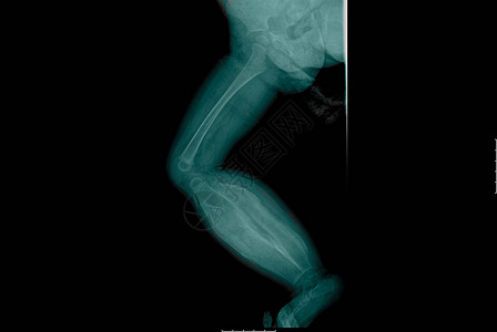 X光显示下的婴儿腿部图片