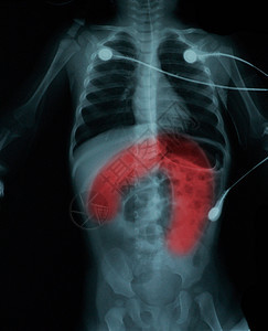 1个月儿童内肠塞体X光图片