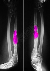 腿部断骨的X光图片