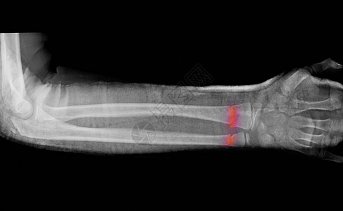 切裂前臂骨折X光图片