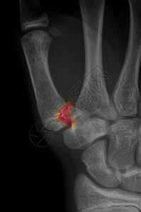 拇指骨形架底部X光图片