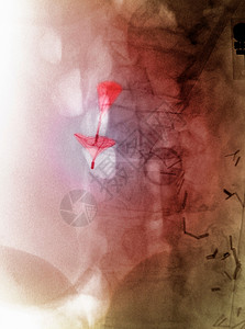 腹部X光照图片