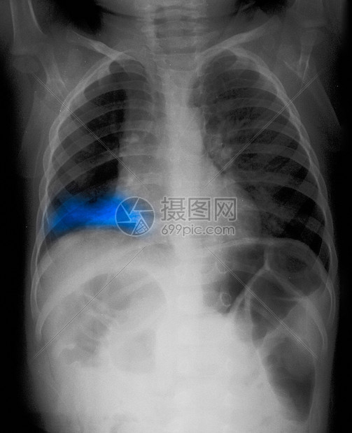 右肺患儿的X射线图片