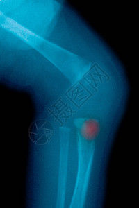 遗传梅毒新生儿膝部的X光图片