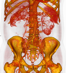 3DCT静脉激素立板扫描低动能图片