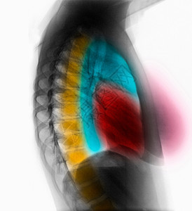 胸部X光片图片
