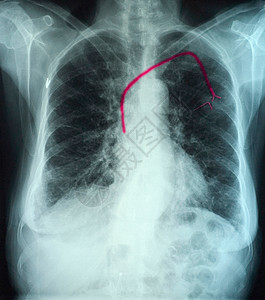 胸前X射线显示心脏有输入端口图片