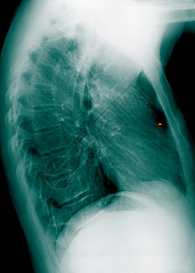 肺部有金属异物的胸部X光片图片