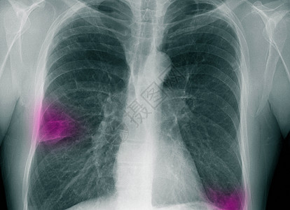 人体切片X光渗透到右肺图片