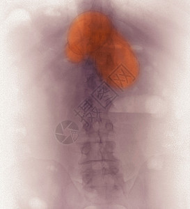 在腹腔X射线上看到的血管伪细胞图片
