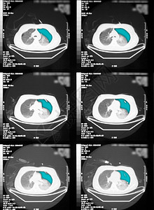 CT扫描左肺气胸图片