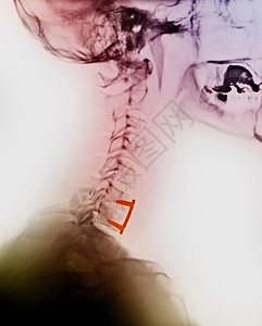 颈脊椎X光检查图片