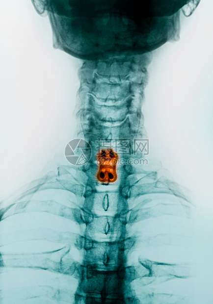 颈脊椎X光检查图片