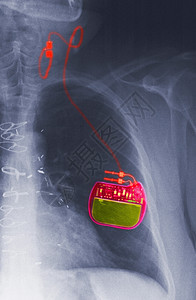 CXR配有癫痫的vagus神经刺激器图片