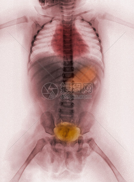 对51周的年幼女婴进行身体X光检查图片