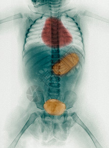 对51周的年幼女婴进行身体X光检查图片