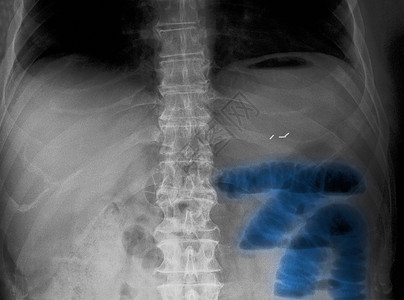 腹部X线小肠梗阻高清图片