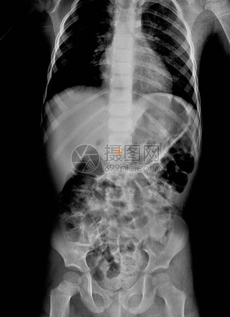 儿童腹部X光片吞食金属珠图片