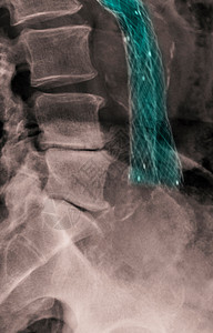 腹部X光显示图片