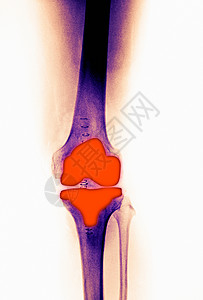 X光下的骨头关节图片