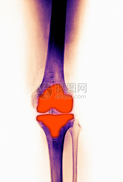 X光下的骨头关节图片