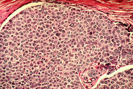 乳腺癌细胞电子显微图图片