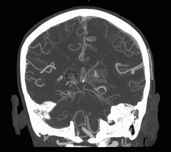 脑CT扫描显利斯血管圈图片