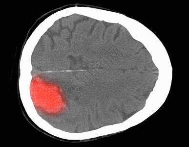 脑部CT扫描显示中风图片