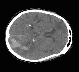 脑部CT扫描显示中风图片