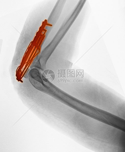 X射线显示近氧化的骨折图片