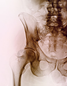 一名男子的臀部X光图片