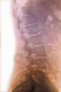 腰脊椎的X射线背景图片