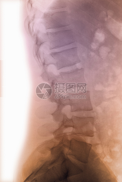 腰脊椎的X射线图片