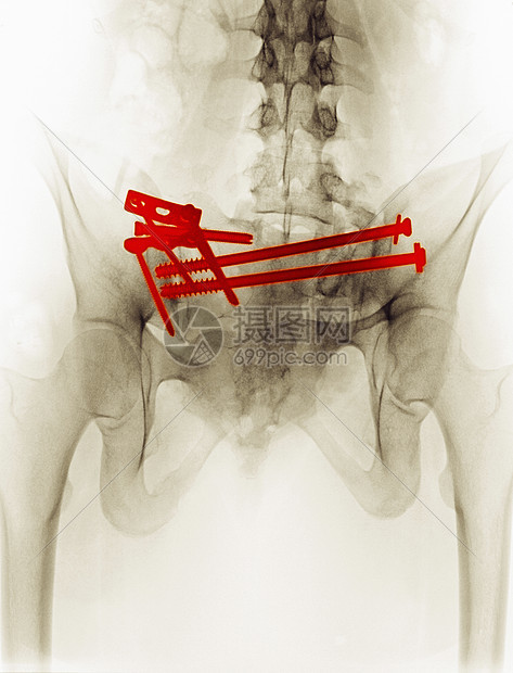 X光显示骨盆骨折手术修复图片