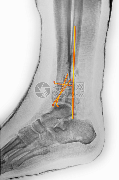 手术后脚踝骨折X光图片