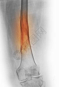 股骨折X射线图片