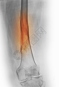 股骨折X射线背景图片