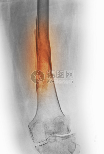 股骨折X射线图片