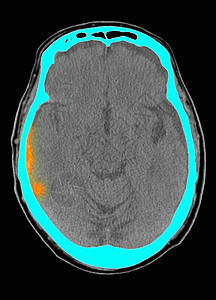 对头部进行CT扫描显示急次硬膜下血肿图片