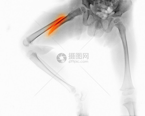 X光片显示一名3岁男孩腿骨折图片
