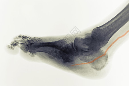 亚糖尿病足部X射线显示凝结动脉图片