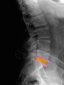 退化的腰脊椎背景图片