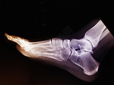 17岁女人正常脚的X光片图片