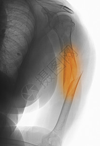 X光片显示Humerus的孔径断裂图片