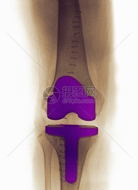 一名61岁女子的关节炎膝盖X光图片