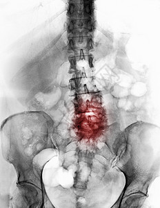 有降解动脉变化的脊椎X射线图片